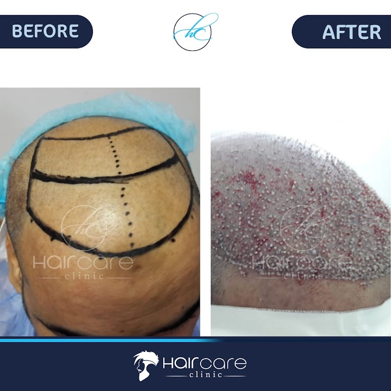 Hair care clinics - هير كير لزراعة الشعر logo