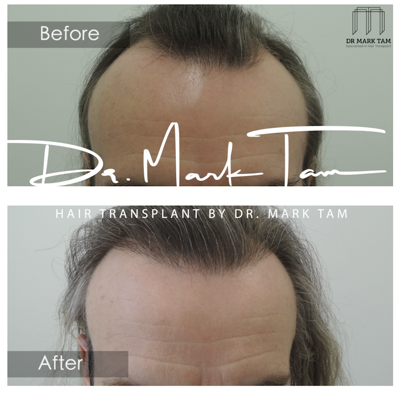 Hair Transplant by Dr Mark Tam logo