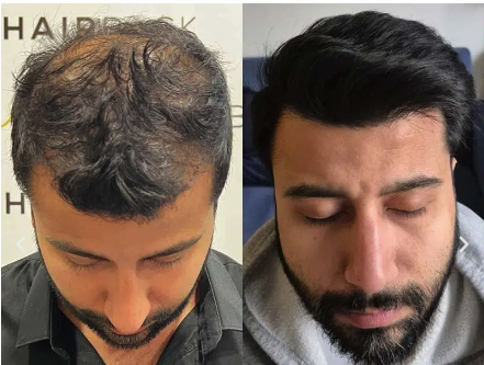 HairBack Clinic - La meilleure clinique de greffe de cheveux en Turquie et en Espagne - DHI - Saphir FUE logo