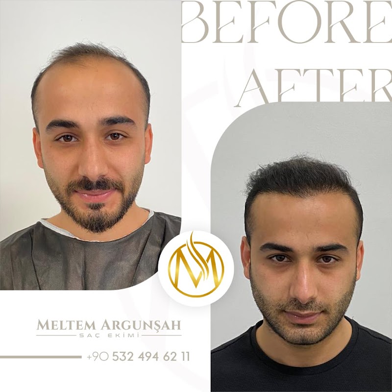 MELTEM ARGUNŞAH SAÇ EKİMİ - DHI, Sapphire & Fue Hair Transplant logo