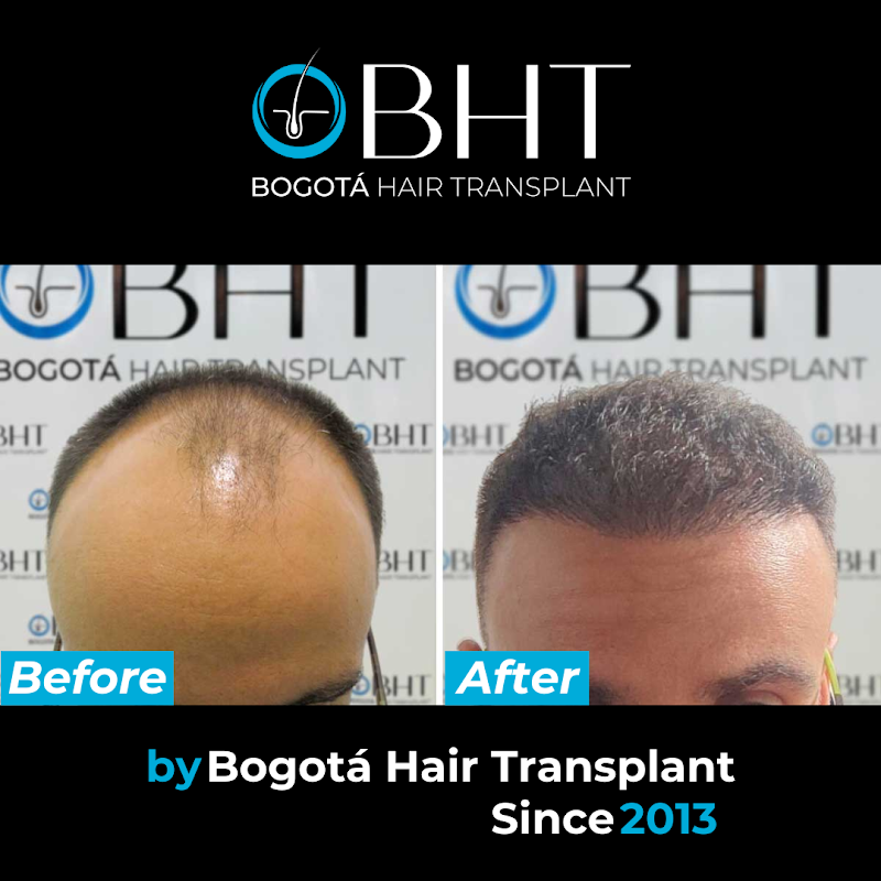 Trasplante capilar bht colombia logo