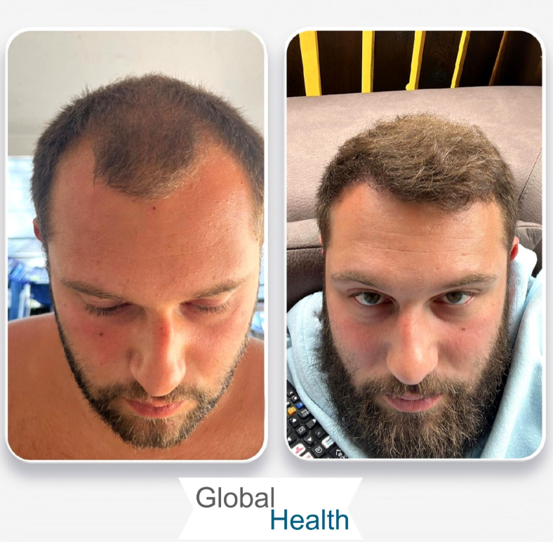 Trasplante Capilar Turquía | Global Health | Hair in Istanbul logo